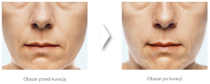 dermatologiabielsko-radiesse1
