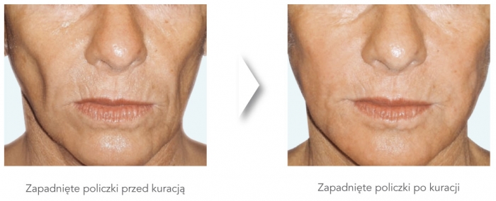 dermatologiabielsko-radiesse3
