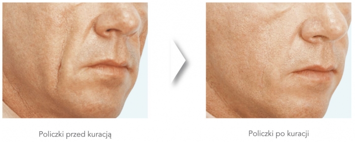 dermatologiabielsko-radiesse4