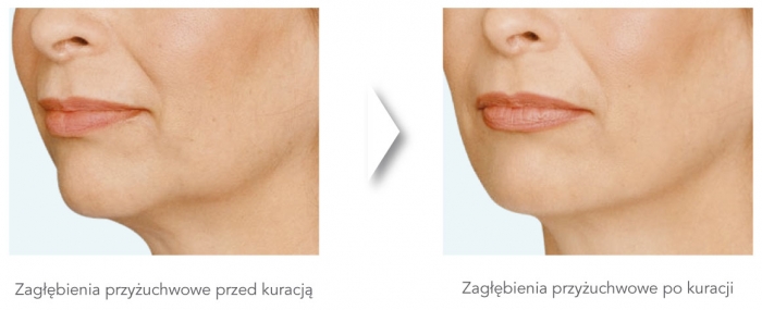 dermatologiabielsko-radiesse5