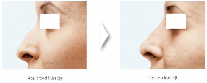 dermatologiabielsko-radiesse6